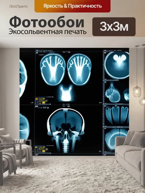 Фотообои самые частые ошибки при интерпретации рентгена