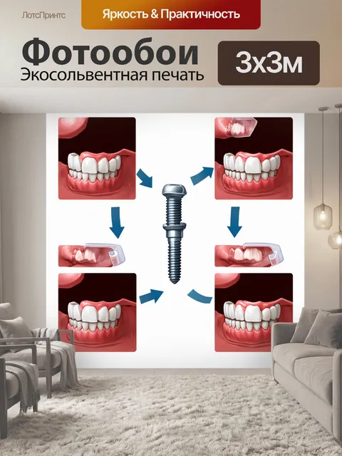 Фотообои серия изображений зубного импланта на разных стадиях процесса установки